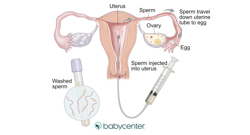 IUI Services in Bhubaneswar