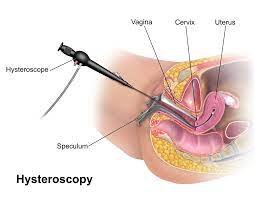 prachi clinic hysteroscopy