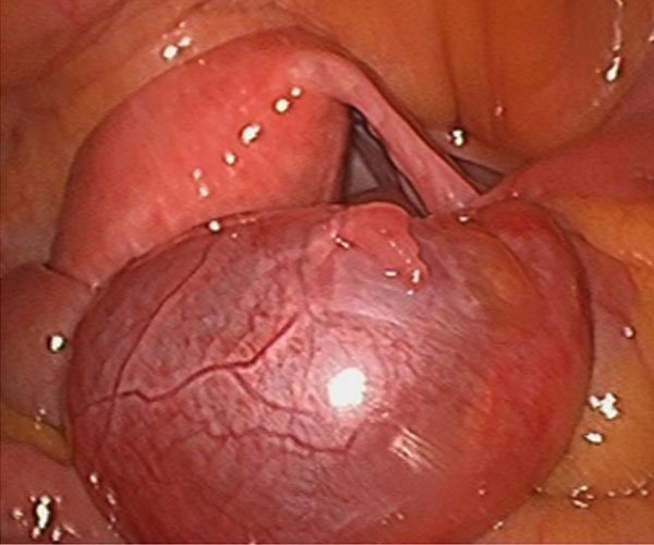Laparoscopy