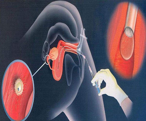Intra Uterine Insemination