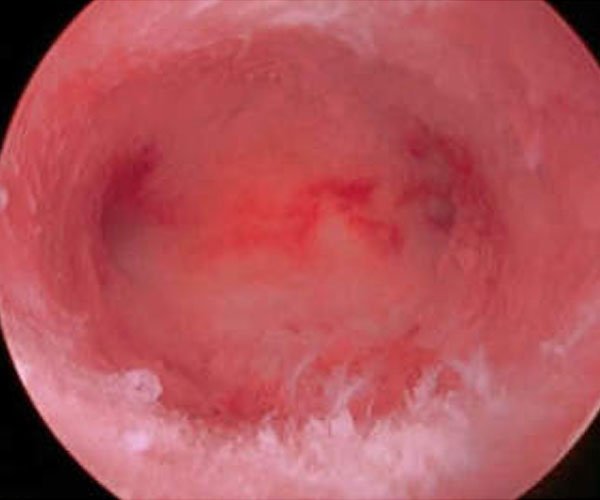 Hysteroscopy